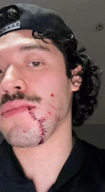 Belfast Giants winger Elijiah Barriga shows off his scars after the incident against the Nottingham Panthers