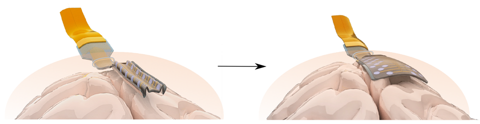 An artist’s impression showing how the electrodes unfold on the brain surface (Massimo Mariello/University of Oxford)