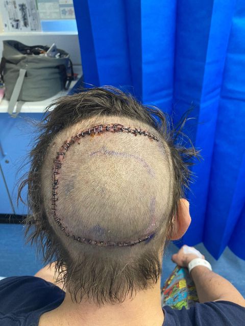 Craig Russell with his post surgery scar (PA)