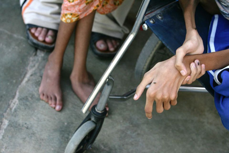 The hand of Anas Hamed (R), and the feet of his sister Inas who suffer from birth defects are pictured on November 12, 2009 in the city of Falluja west of Baghdad, Iraq