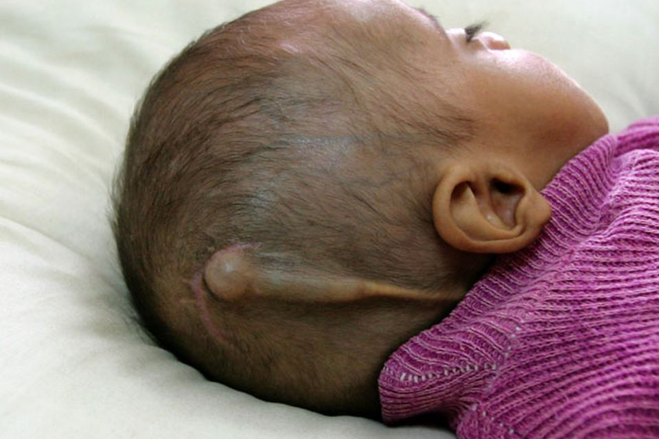 An Iraqi child suffering from a birth defect is pictured on November 12, 2009 at Falluja General Hospital in the city of Falluja west of Baghdad, Iraq