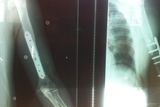 thumbnail: X-rays of plates in Franck Petricola’s arm after last year’s NW200 crash