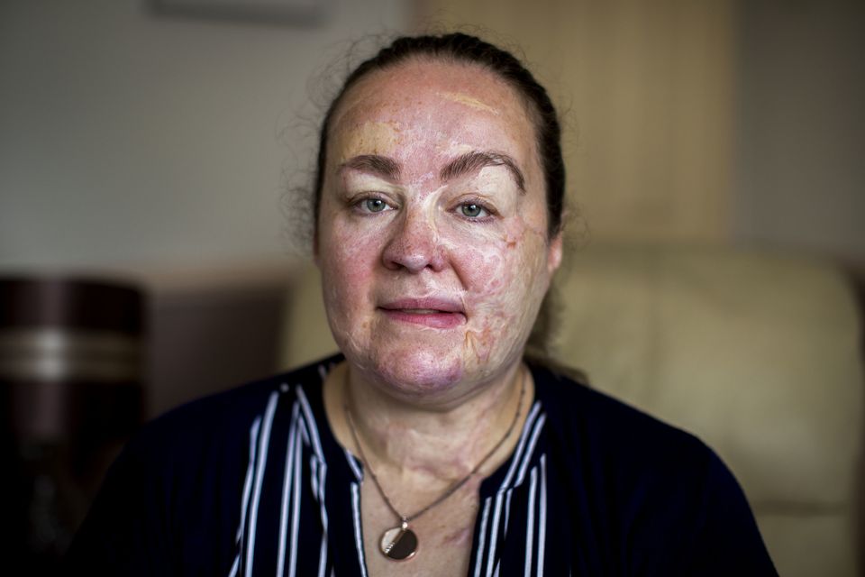 Omagh bombing survivor Donna-Marie McGillion, said she still lives with daily pain (Liam McBurney/PA)