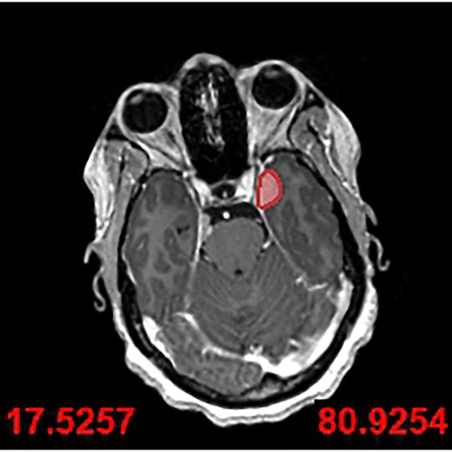 An MRI scan used by surgeons to visualise Ruvimbo Kaviya’s tumour (Leeds Teaching Hospitals NHS Trust/PA)