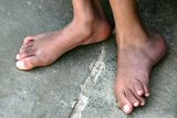 thumbnail: FALLUJA, IRAQ - NOVEMBER 12: The feet of Inas Hamed, who suffers from a birth defect are pictured on November 12, 2009 in the city of Falluja west of Baghdad, Iraq. Birth defects have soared in Fallujah, which was the site of two major battles between the U.S military and insurgents after the invasion of Iraq according to Iraqi doctors. (Photo by Muhannad Fala'ah / Getty Images)