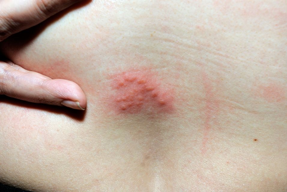 Shingles causes a painful rash and can sometimes lead to serious problems such as deafness, long-lasting pain, and blindness (John Davidson Photos/Alamy/PA)