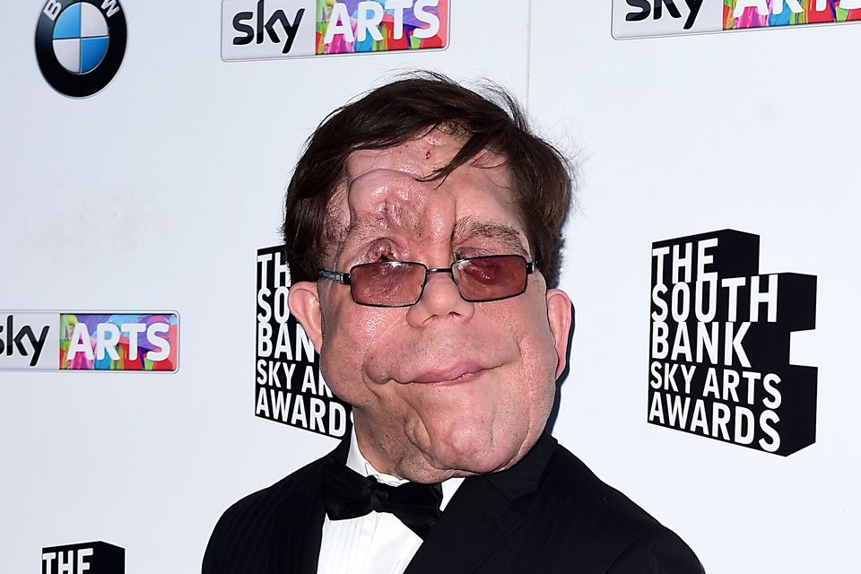 Actor, presenter and campaigner Adam Pearson, who has neurofibromatosis (Ian West/ PA)