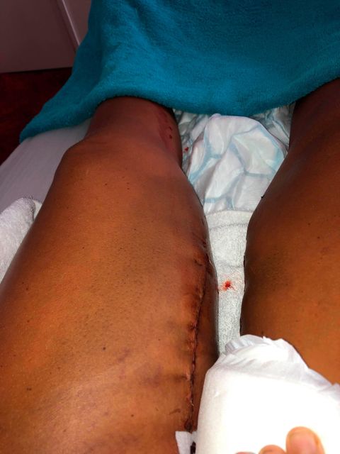 Michelle Heath's leg after surgery