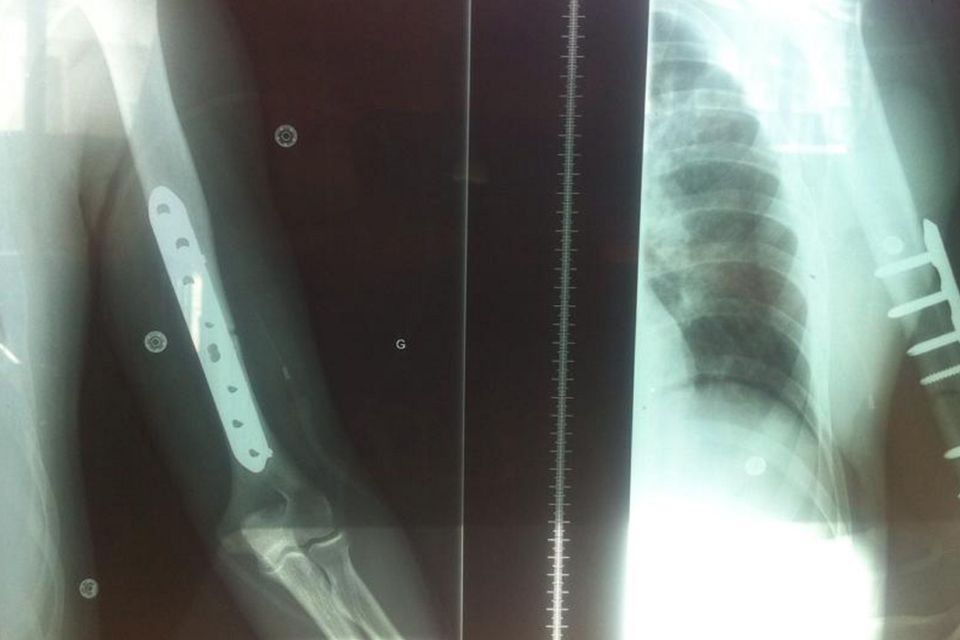 X-rays of plates in Franck Petricola’s arm after last year’s NW200 crash