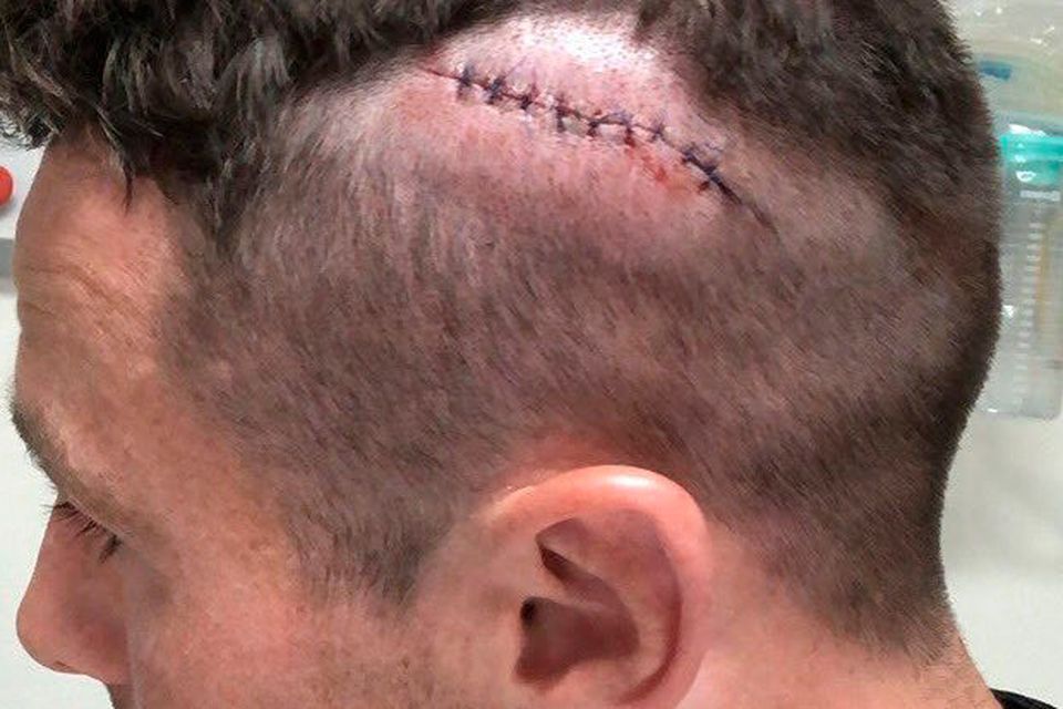 stitches in head