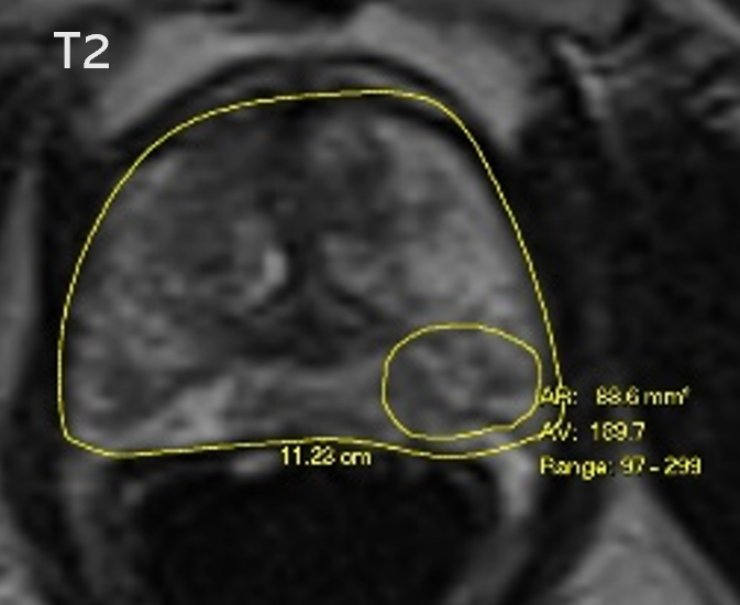 An MRI image showing only one tumour found (Heriot-Watt/PA)