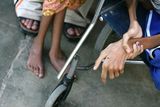 thumbnail: The hand of Anas Hamed (R), and the feet of his sister Inas who suffer from birth defects are pictured on November 12, 2009 in the city of Falluja west of Baghdad, Iraq