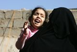 thumbnail: Mariam Yasir (L), age 6 years old, who suffers from a birth defect, cries as her mother carries her on November 12, 2009 in the city of Falluja west of Baghdad, Iraq